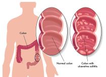 ulcerative-colitis